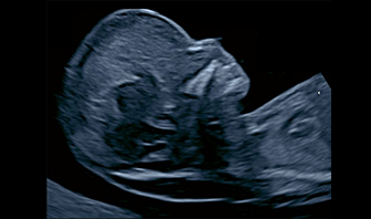 首のむくみ(NT)専門外来